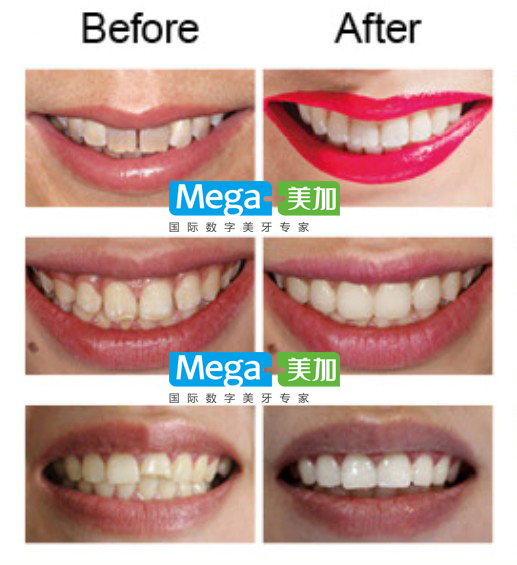 明星的牙用什么美白的,牙齿美白全过程视频