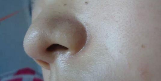 痘痘肌肤毛孔粗大做什么医美,痘痘毛孔粗大怎么修复平价