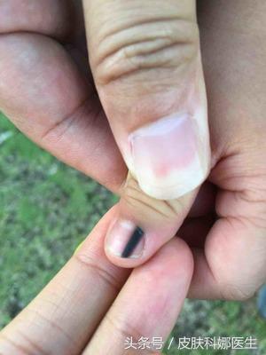 指甲上有很短的黑色线怎么回事,指甲上面出现一条黑线