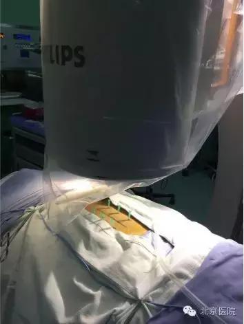 北京腰椎骨折微创手术,北京骨科大腿骨头骨折手术