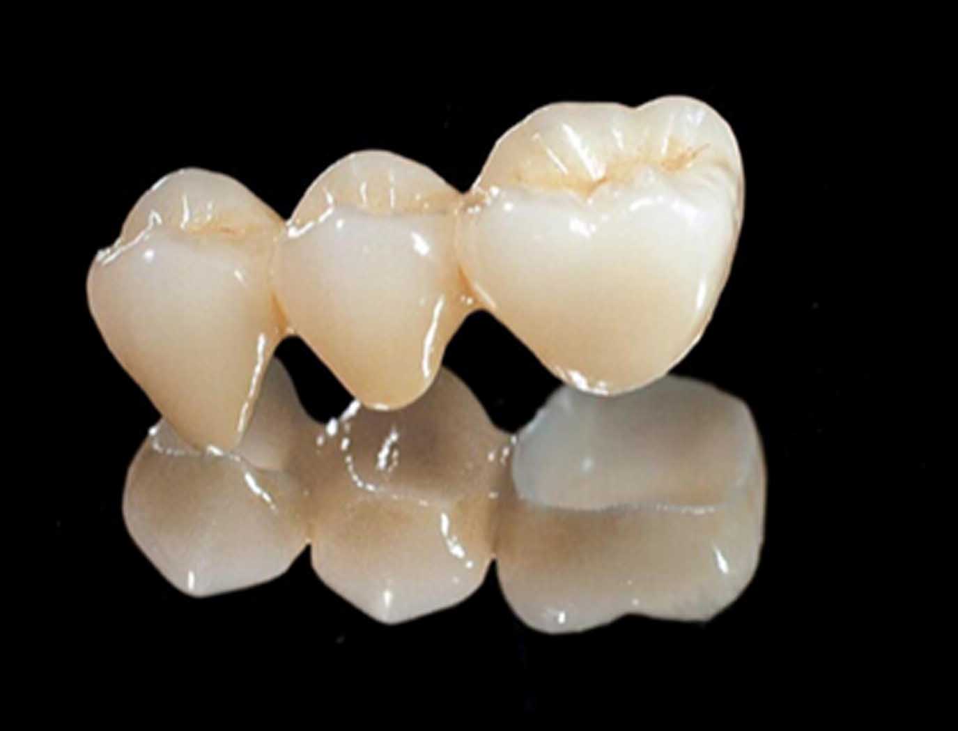 烤瓷牙会不会变颜色,烤瓷牙会有几种颜色