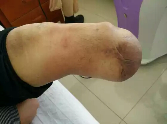 残疾朋友须要注意了：硅胶套，我须要配戴吗？