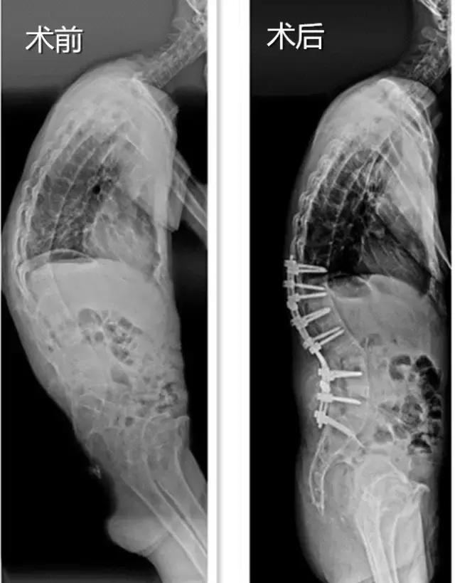 40岁壮汉背弯得像只虾,看看医生是怎么将他“拉直”的