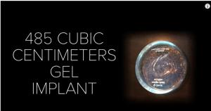 隆过的胸和正常的胸有什么区别,隆过的胸是不是很硬