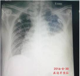 心梗后胸腔积液怎么办,心梗胸腔积液