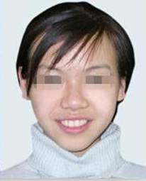 牙齿不齐可以戴隐形牙套吗,牙齿不齐一定要戴钢牙吗