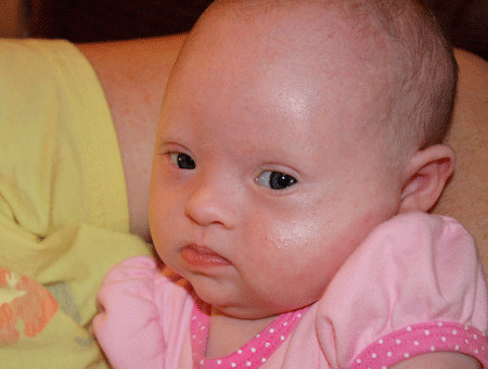 患有唐氏综合征的宝宝,唐氏综合征宝宝越吃越瘦