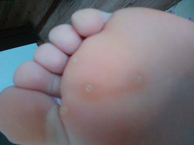 鸡眼怎么能彻底根治治疗鸡眼的7个生活小偏方