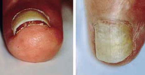 观手知健康指甲有白点怎么回事,当指甲发绿发脓的时候要怎么处理