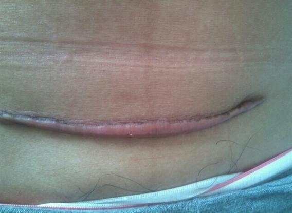 剖腹产的痛只有剖腹产的人才知道,你以为的剖腹产实际的剖腹产