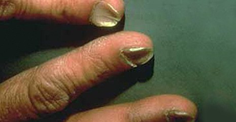 指甲的变化意味着身体的健康状况,指甲上出现这7症状是大病预兆