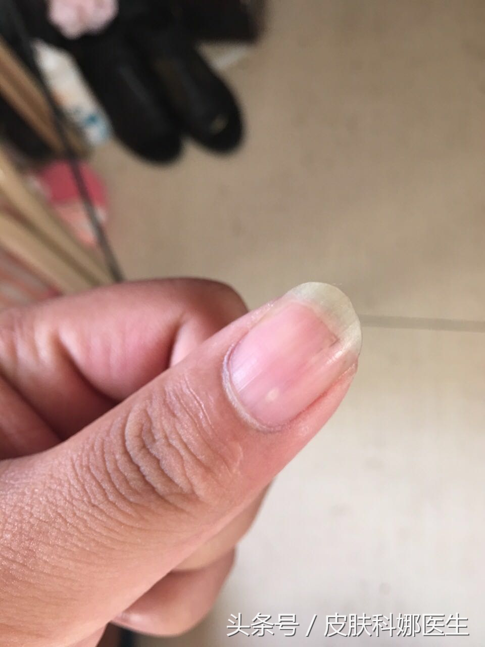 指甲上出现了一条裂缝,指甲上有竖条纹开裂是怎么回事