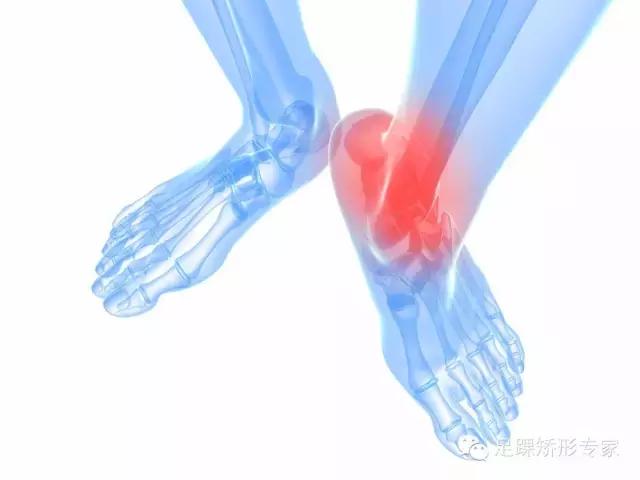 脚踝轻微扭伤不影响走路怎么消肿,足踝扭伤韧带撕裂的恢复过程