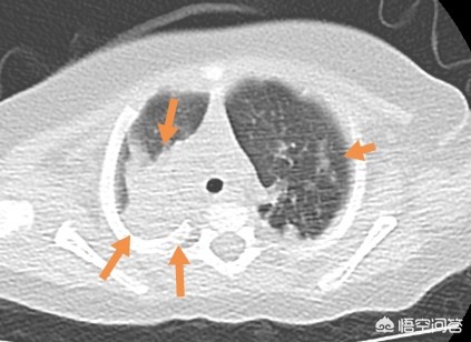 小孩得了肺炎需要打疫苗吗,小孩得了肺炎要打疫苗吗