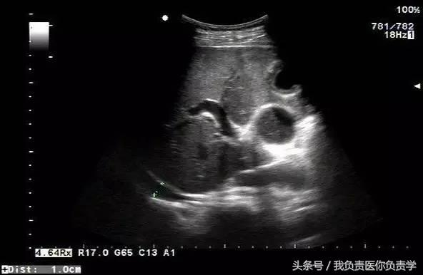 楂樻墜杩涢樁鑵拌吂璁粌,鑳嗗泭缁撶煶绌垮瓟鐥囩姸