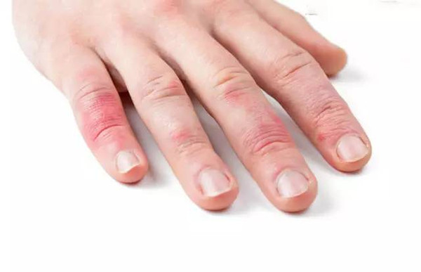 冻疮族的福音！预防冬季冻疮有妙法！