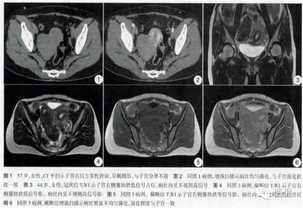 病例丨病理结果「医看」有奖阅片大赛病例资料8：右侧卵巢纤维瘤#医学影像#