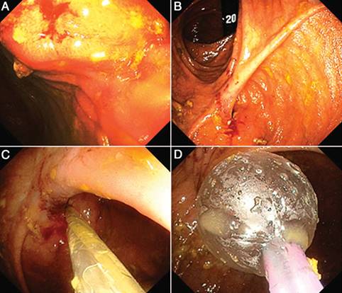 克罗恩病内镜严重程度指数,克罗恩病内镜检查是怎么样的