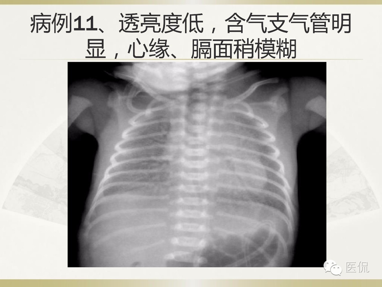 「资料丨医看分享」南边老师肺部群：新生儿透明膜病（HMD）医学影像