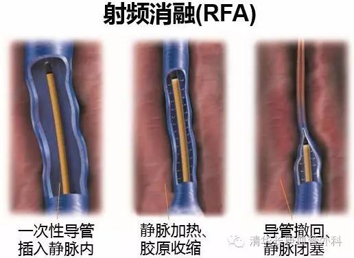 专家讲堂静脉曲张怎么治疗,静脉曲张微创射频闭合术