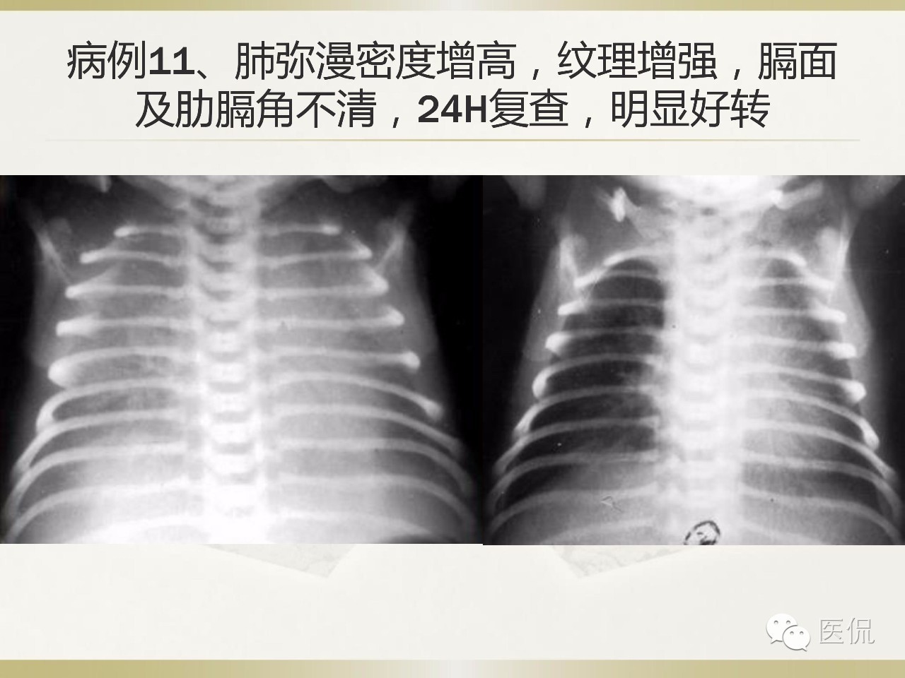「资料丨医看分享」南边老师肺部群：新生儿透明膜病（HMD）医学影像