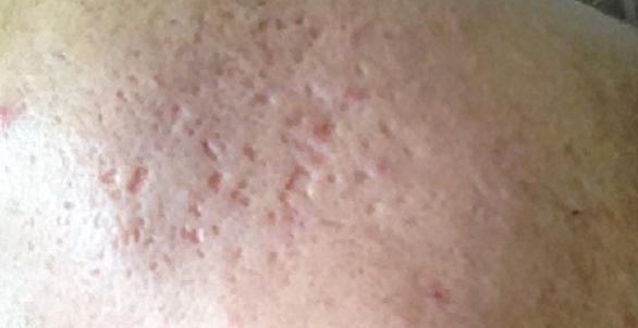 真正祛痘印有效的方法,最简单有效祛痘印的方法