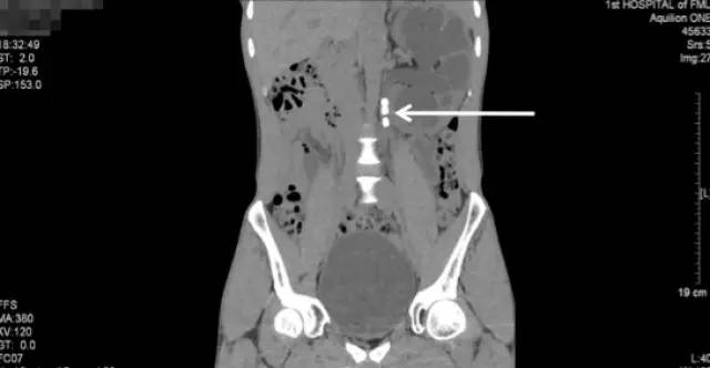 肾结石治疗最佳方案钬激光碎石,治疗肾结石案例