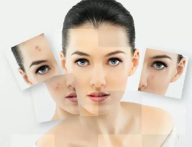 挤痘痘注意方法,在脸上挤痘痘其实是个危险的动作