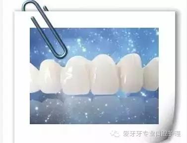 烤瓷牙和全瓷牙的区别和价格,贵的烤瓷牙和便宜的有区别吗