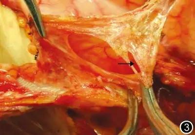 不明原因腹痛胰腺,右上腹痛与胰腺疾病有关系吗