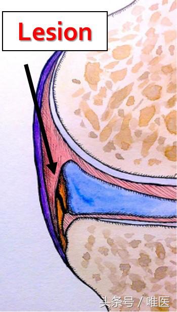 膝关节内侧后角半月板1度损伤,右膝关节内侧半月板后角变性损伤