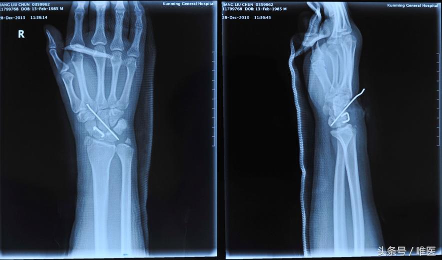 月骨舟骨半脱位手术,手腕舟骨月骨周围脱位要多久康复