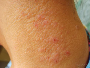 神经性皮炎痒怎么回事,神经性皮炎痒得厉害怎么办