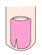 大拇指指甲出现纵纹凸出是什么病,指甲出现黑色的纵纹