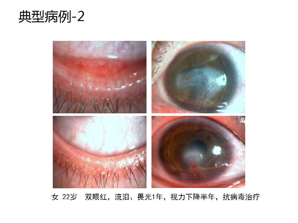 眼睑缘炎的发病原因,眼睑炎的症状和治疗方法