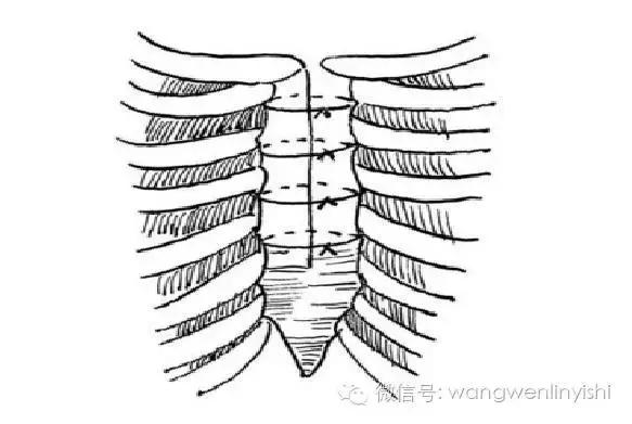 图与真相：什么是胸骨裂？