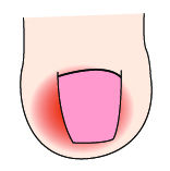 指甲出现白点、纵纹是怎么回事?