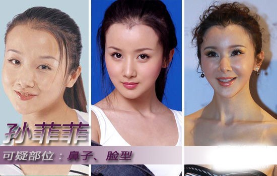 整容保质期大概多久,明星整容一般多久恢复