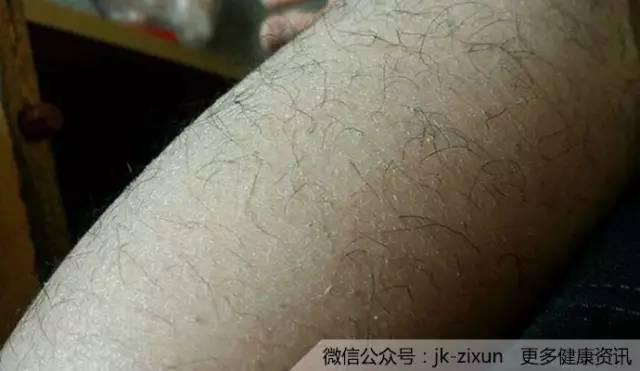 冬天腿上皮肤干燥起皮屑吃哪个药,冬天裤子上很多白色皮屑怎么去除