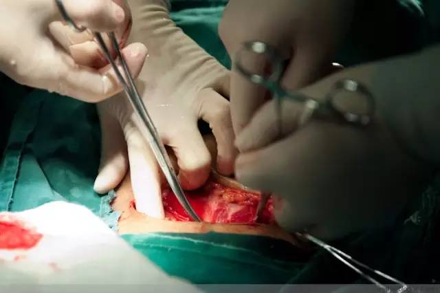 剖腹产恢复很好的照片,剖腹产完全恢复照片