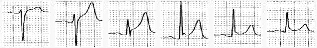 心电图st段呈j点型抬高是什么意思,心电图st段抬高一定是心梗吗
