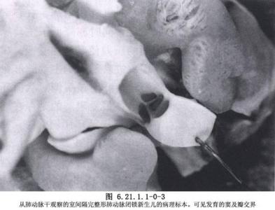 新生儿肺动脉闭锁治疗方案,室间隔缺损合并肺动脉闭锁定义