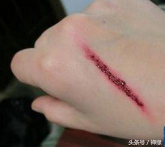 宝宝伤口愈合后怎么护理,宝宝伤口怎么预防感染