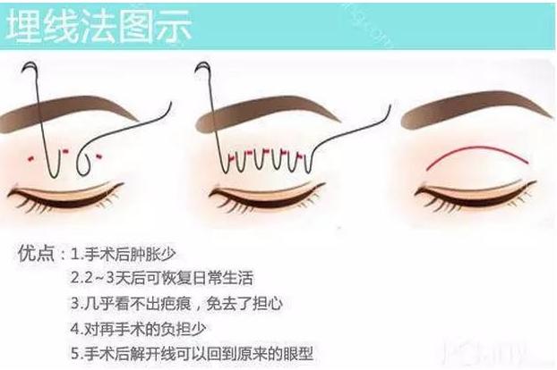 日本纳米无痕双眼皮加开眼角,纳米无痕双眼皮15天恢复图
