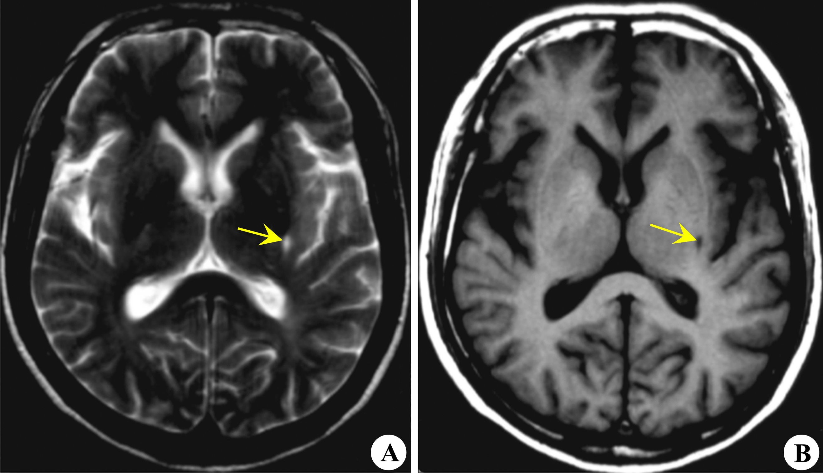 ct诊断颅内多发脑梗死,ct报告脑梗灶是啥意思