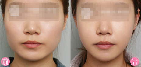 下巴太短有什么影响吗,下巴太尖是不是不好