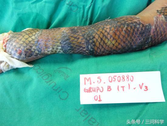 烫伤了不痛,鱼皮治疗烫伤疤痕可以吗