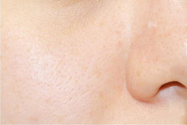 长痘痘的原因和改善方法脸颊长痘,右脸颊起痘痘什么原因