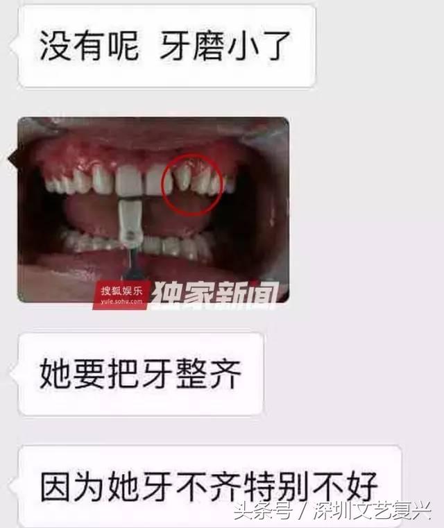 林允整牙效果怎么样,林允整牙后变化图片