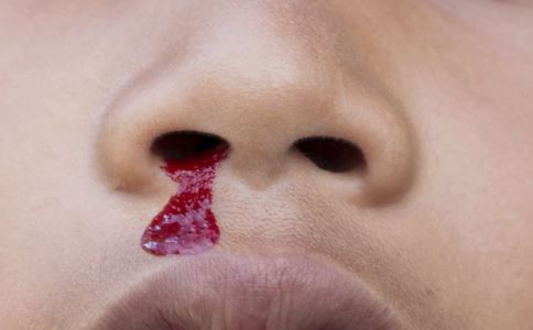 冬季流鼻血怎么排除白血病,冬季孩子流鼻血怎么处理